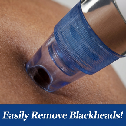 DermaSuction™ Pore Vacuum Blackhead Extractor