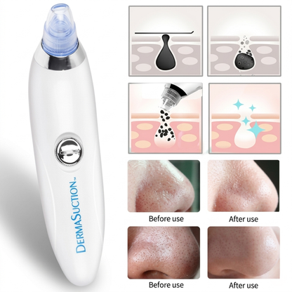 DermaSuction™ Pore Vacuum Blackhead Extractor